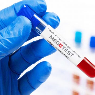 Hepatito A viruso (HAV) IgM nustatymas