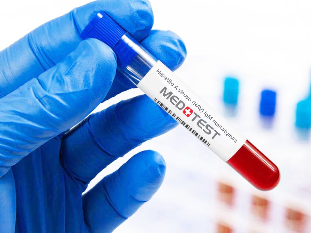 Hepatito A viruso (HAV) IgM nustatymas