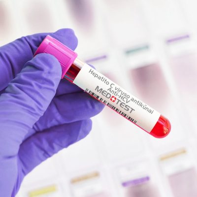 Hepatito C viruso antikūnai Anti-HCV