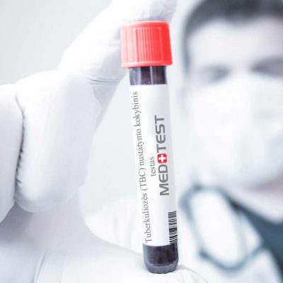 Tuberkuliozės (TBC) nustatymo kokybinis testas