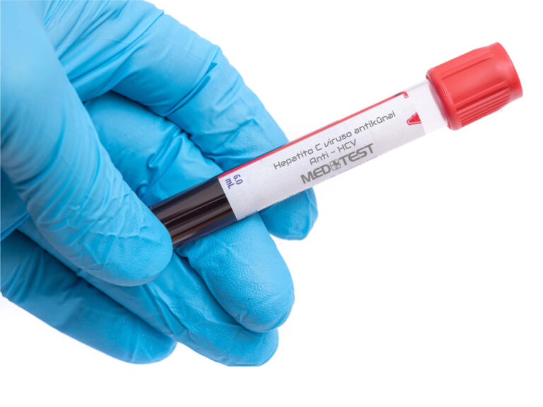 (Anti - HCV) Hepatito C viruso antikūnai - Medtest laboratorija